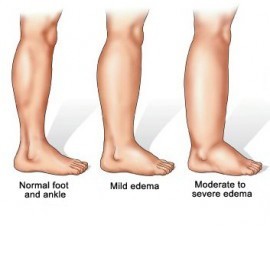 edema.jpg