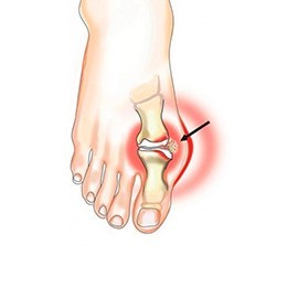 gout (1).jpg